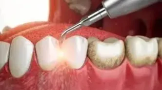 شاید باورتان نشود این مورد اصلی ترین علت دندان درد ست!