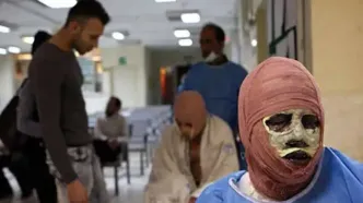 ۹۰ درصد بیماران سوخته از فقرا هستند/ سالانه سه‌هزار نفر بر اثر سوختگی می‌میرند