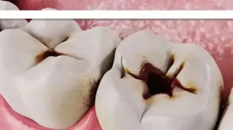 شایع‌ترین علت پوسیدگی دندان چیست؟