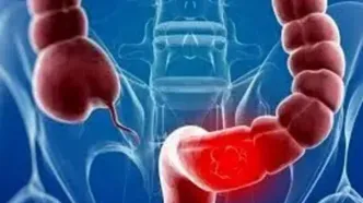 هشدار| این افراد مستعد سرطان روده بزرگ هستند!