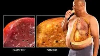 این ها مهم ترین عوامل برای کبد چرب  هستند!