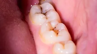 راز پوسیدگی دندان کشف شد