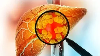 کبدت چند درجه چرب شده؟ اینفوگرافیک + درجه‌بندی واقعی!