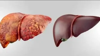 راه قطعی تشخیص کبد چرب کدام است؟ آزمایش یا سونوگرافی؟