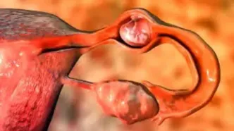 آیا این مورد عامل  سقط جنین  است؟