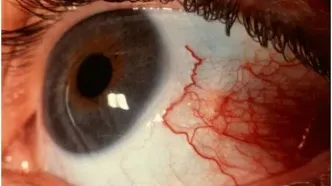 اقدامات اولیه و اورژانسی آسیب های چشمی