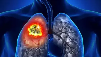نقطه ضعف سرطان ریه را کشف شد