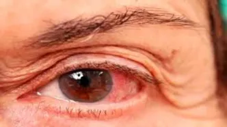 چرا به آب سیاه مبتلا می شویم؟