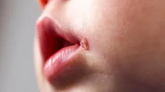 آفت و تبخال در کودکان چه تفاوتی دارد؟