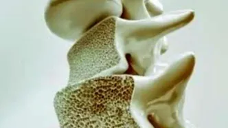 این علائم یعنی استخوان‌های شما پوک می‌شود!