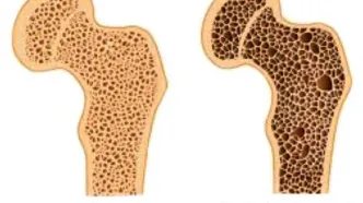 این علائم یعنی استخوان های شما پوک می‌شود
