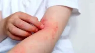آلرژی به بادمجان این علائم را دارد