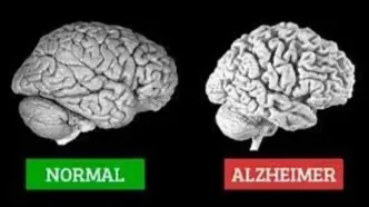 آلزایمر چیست، نشانه هایش کدام است و چه کنیم مبتلا نشویم؟