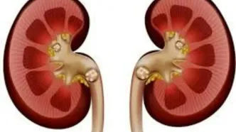 این تغذیه عامل اصلی سنگ کلیه است!