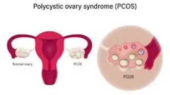 ارتباط PCOS  با کبد چرب