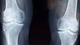 امید تازه برای درمان آرتروز