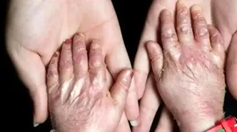 شناسایی ۴۹۲ گونه بیماری نادر و چالش‌های هزینه‌های درمانی در ایران