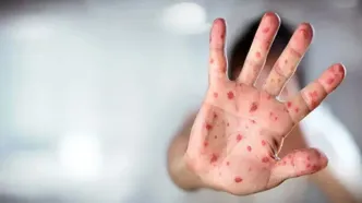 شیوع سرخک ۵۰۰ کودک بنگلادشی را کشت