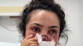 شوهر این خانم از عصبانیت دماغشو گاز گرفت و از جا کند