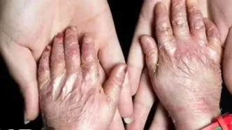 وقتی قطع برق زخم ها را دوباره باز می‌کند/ درد پنهان بیماران پروانه ای