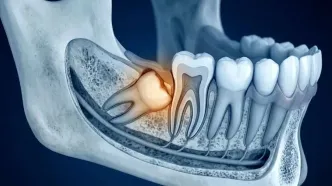 زمان مناسب برای جراحی دندان عقل نهفته چه زمانی است؟