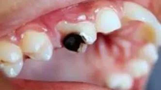 این نوشیدنی بیشتر از نوشابه برای دندان مضر است!