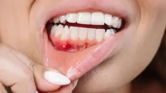 جایگزین طبیعی آنتی‌بیوتیک برای درمان بیماری شدید لثه