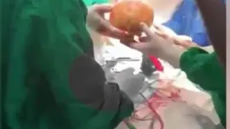 خارج کردن سنگ مثانه به وزن ۳.۱ کیلوگرم از بدن بیمار ۵۵ ساله