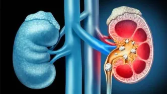 گرمای تابستان چه بلایی سر کلیه‌ها می‌آورد؟ راهکارهای پیشگیری از سنگ کلیه