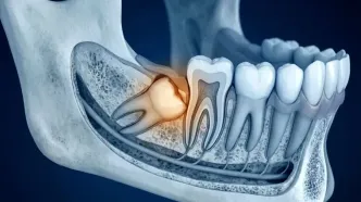 دندان عقل نهفته؛ چه زمانی جراحی ضروری می‌شود؟