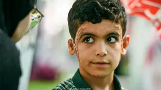 تصویری تلخ از آثار بمباران روی صورت دانش‌آموز مینابی