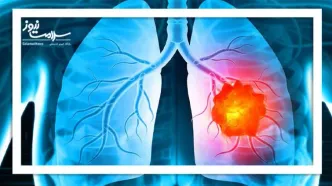 میکروپلاستیک‌های استنشاقی و خطر ابتلا به سرطان ریه