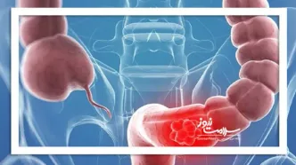 نقش ویتامین D در افزایش بقای بیماران مبتلا به سرطان کولورکتال