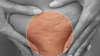 سلولیت‌ چیست و درمان آن کدام است؟