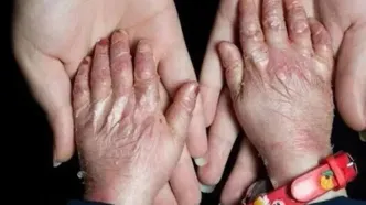 به داد بیماران پروانه ای برسید