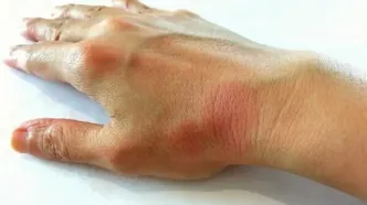 امید به درمان و مهار لوپوس