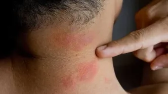 چه هنگام باید  خارش مداوم پوست را جدی بگیریم؟